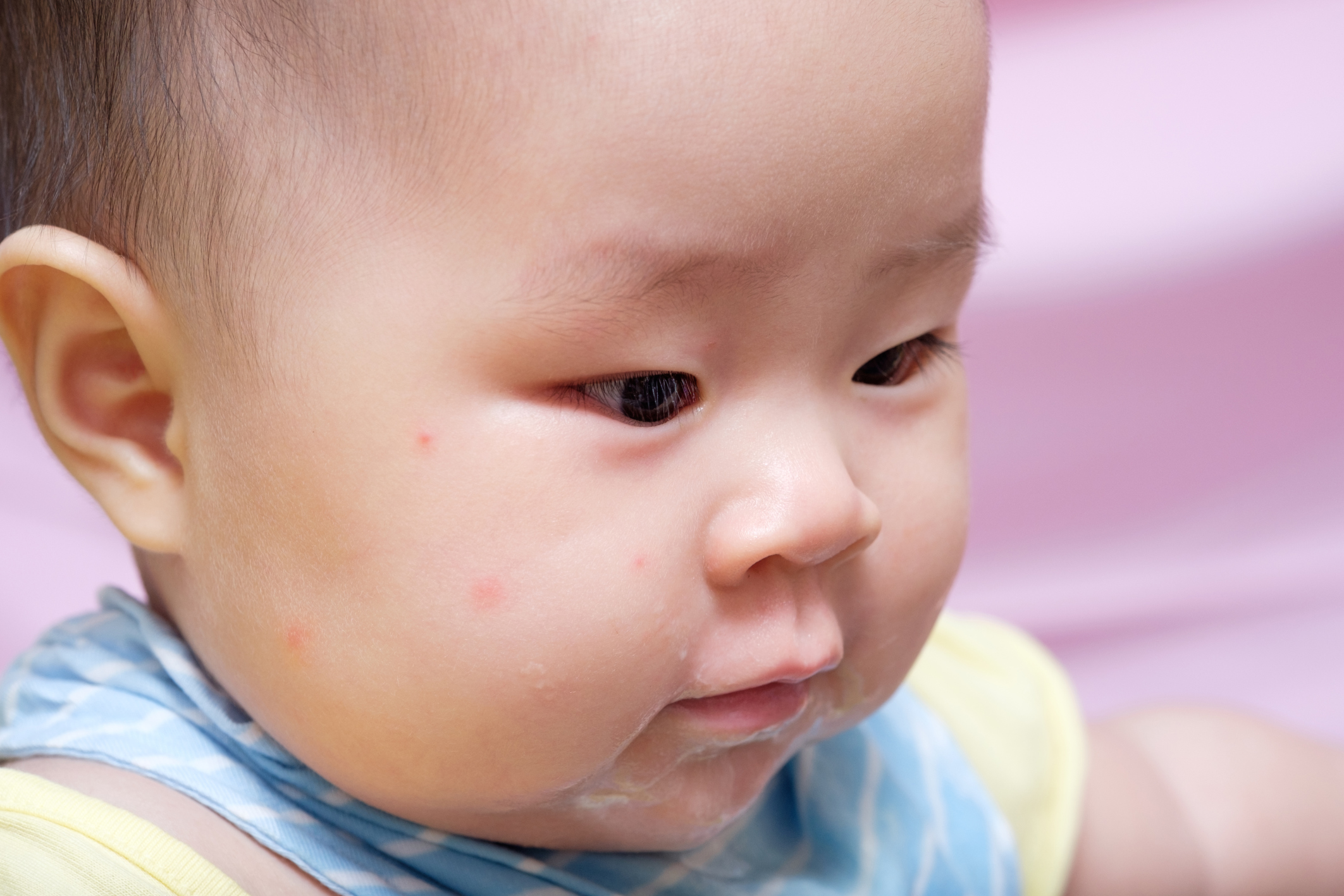 Укус комара на лице у ребенка