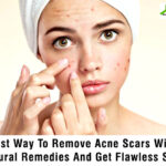 Best Way To Remove Acne Scars With Natural Remedies And Get Flawless Skin