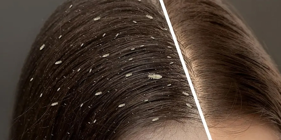 For Lice in hairs