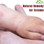 How To Naturally Care Eczema | Home Remedies For Eczema