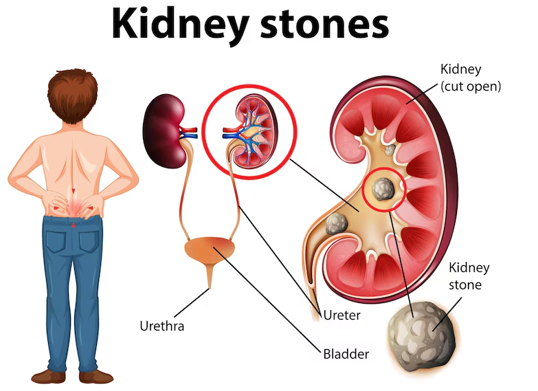 Home Remedy for Scanty Urination