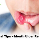 Natural Tips – Mouth Ulcer Remedy