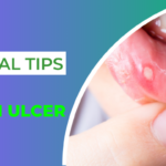 Natural Tips for Mouth Ulcer