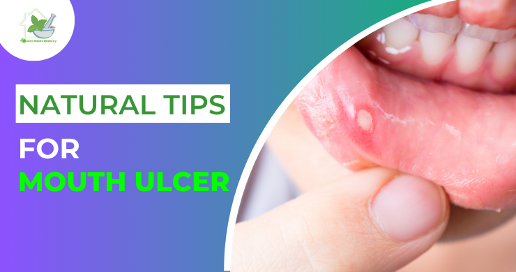 Natural Tips for Mouth Ulcer