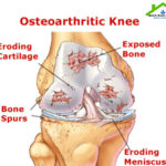 Natural Cure For Osteoarthritis – Natural Remedies
