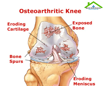 Natural Cure For Osteoarthritis – Natural Remedies