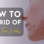 Get Rid Of Acne In Few Weeks