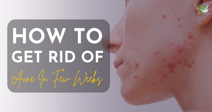 Get Rid Of Acne In Few Weeks