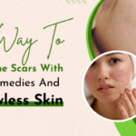 Best Way To Remove Acne Scars With Natural Remedies And Get Flawless Skin