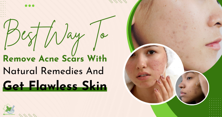 Remove acne scar home remedy