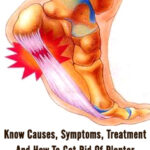Know Causes, Symptoms, Treatment And How To Get Rid Of Plantar Fasciitis Pain?