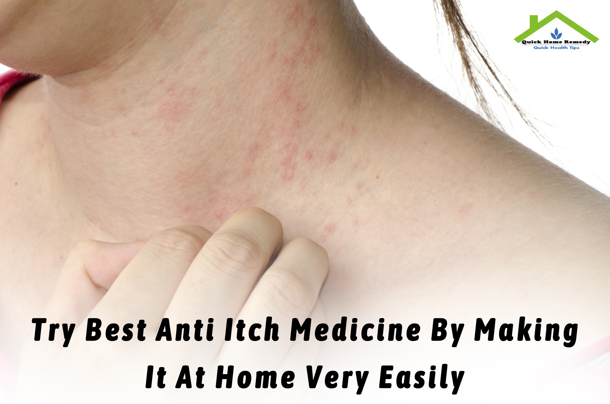 Try Best Anti Itch Medicine By Making It At Home Very Easily