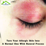 Turn Your Allergic Skin Into A Normal One With Natural Process