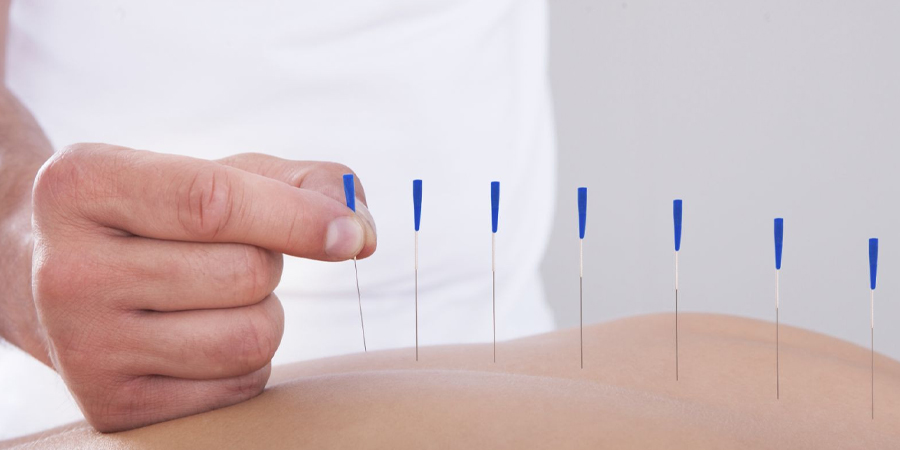 Try acupuncture