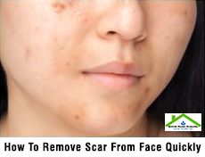 How To Remove Scar From Face Quickly – Quick Tips