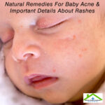 Natural Remedies For Baby Acne And Important Details About Rashes