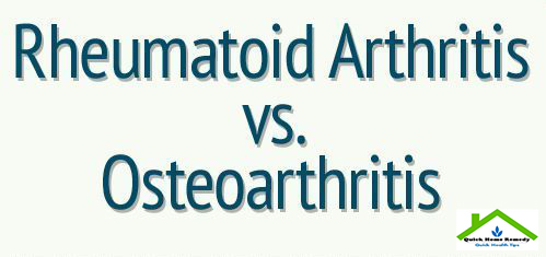 Difference Between Osteoarthritis And Rheumatoid Arthritis | Arthritis Home Remedies