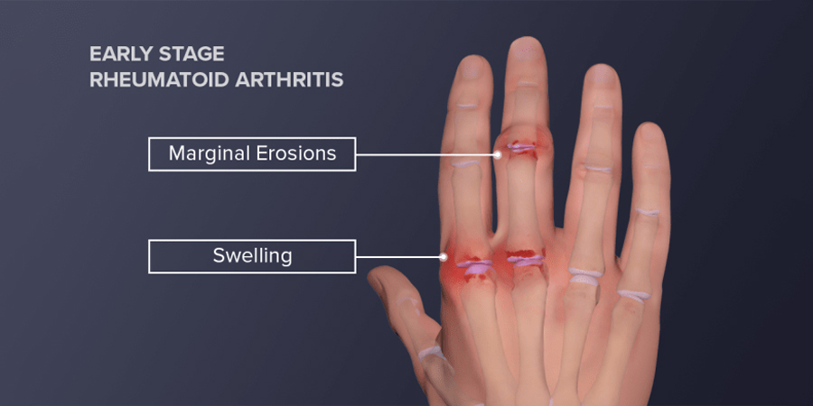 Rheumatoid arthritis