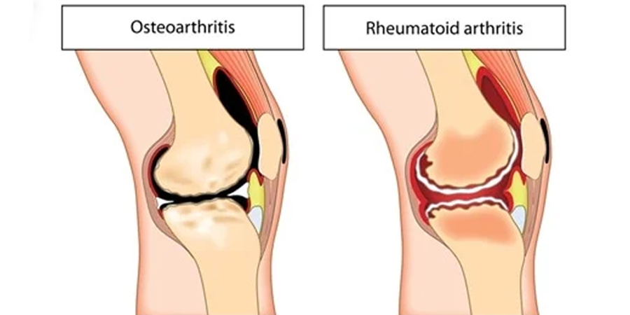 characteristics of OA and RA