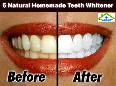 5 Natural Homemade Teeth Whitener