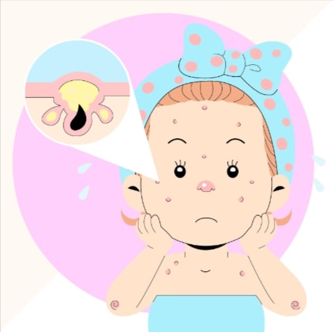 Natural Remedies for Baby Acne and Essential Information About Rashes