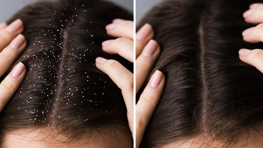 Home Remedy To Cure Dandruff Permanently