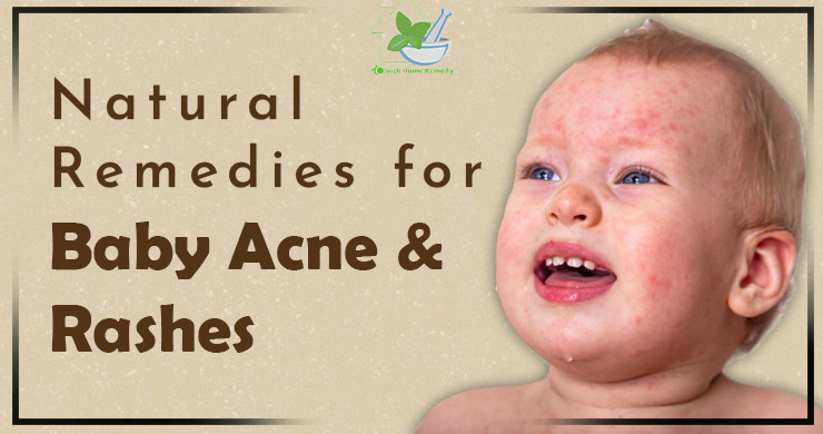 Natural Remedies for Baby Acne and Essential Information About Rashes