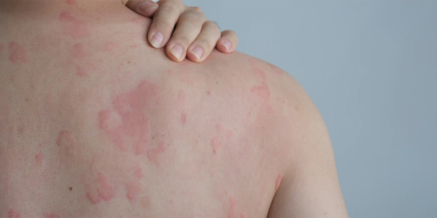 Rashes & allergic reactions