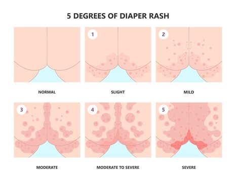 Symptoms and Types of diaper rash