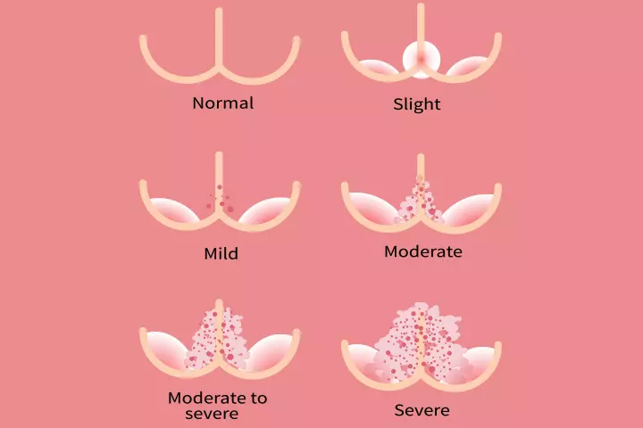 Types of Diaper Rash