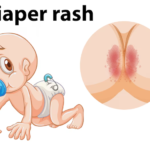 Diaper Rash Home Remedy For Babies